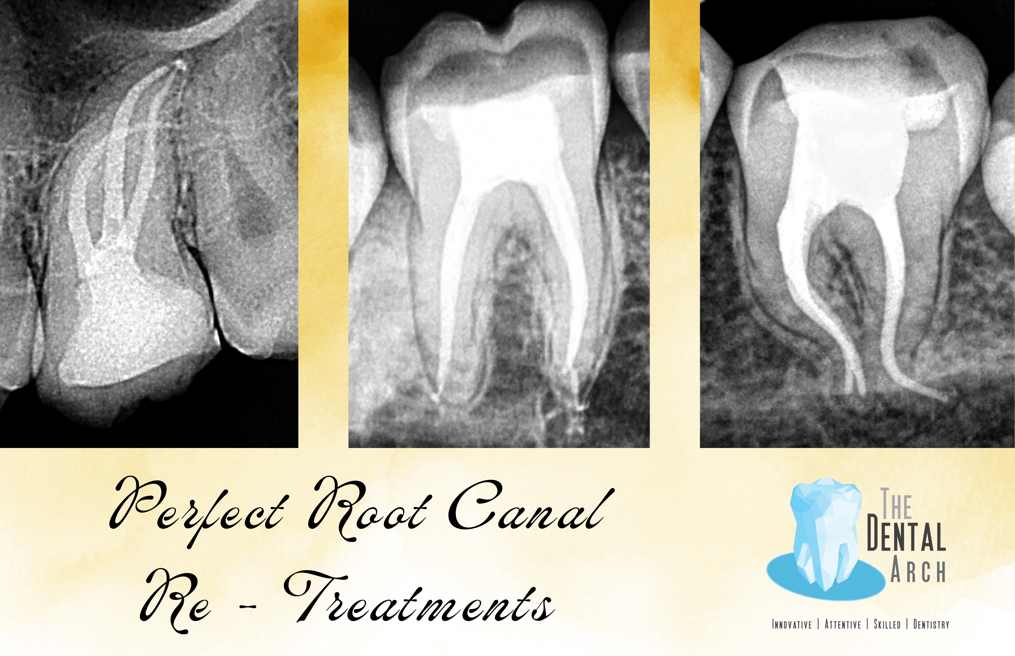 Best Root Canal Retreatment Dentist Mumbai