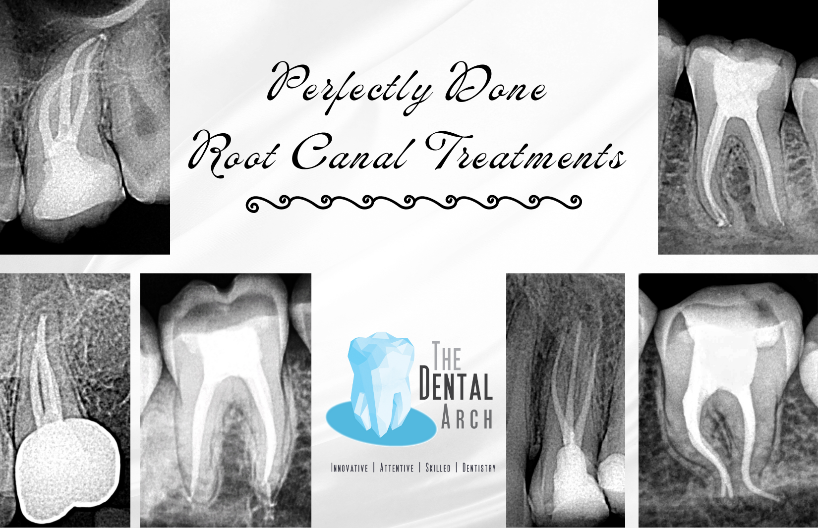 Root Canal Dental Treatment Bandra, Mumbai